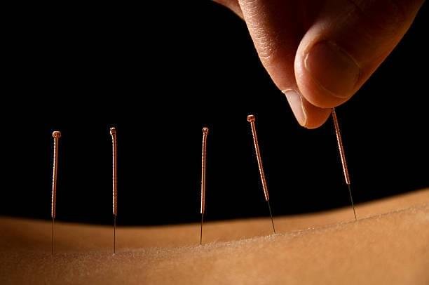 Fine acupuncture needles placed along the lower back